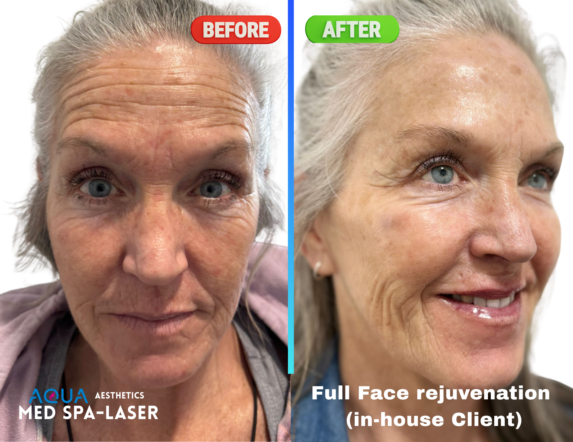 Complete Rejuvenation